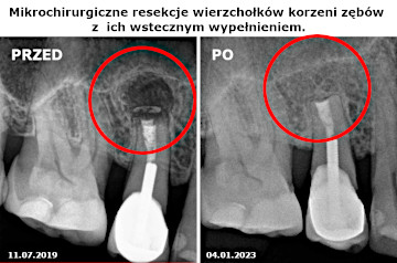 Resekcje korzeni zębów Gliwice